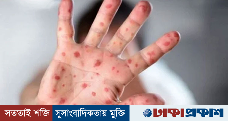 ২৪ ঘণ্টায় হাম উপসর্গে আরও ৭ জনের মৃত্যু, নতুন আক্রান্ত ১,৩২৭